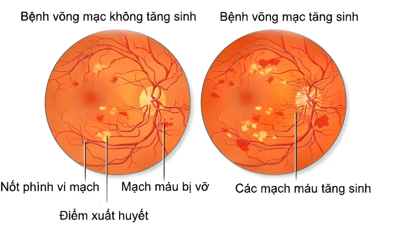 Biến chứng võng mạc đái tháo đường là gì? Triệu chứng và phương pháp điều trị