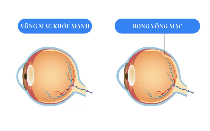 Bong võng mạc có chữa được không? Điều trị như thế nào?
