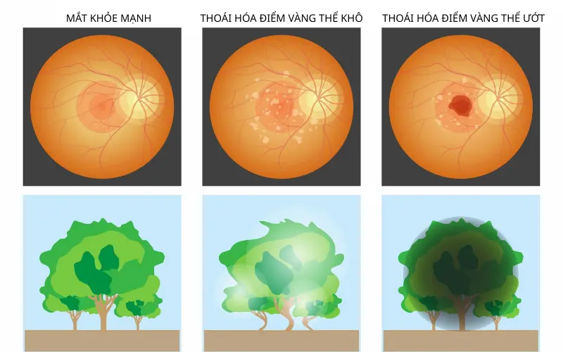 dấu hiệu thoái hóa điểm vàng