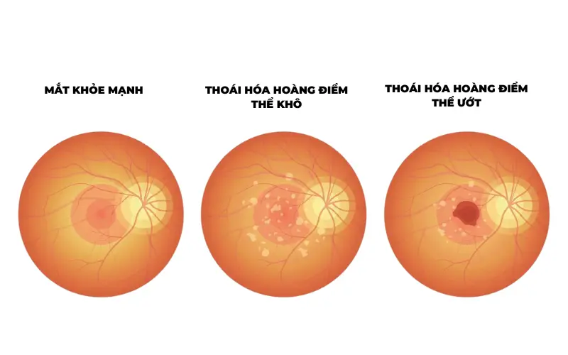 hai thể bệnh thoái hóa hoàng điểm chính