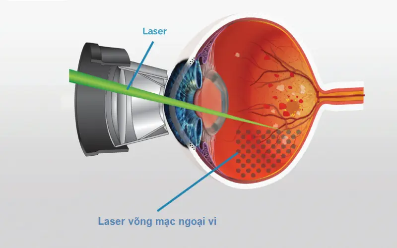 laser quang đông