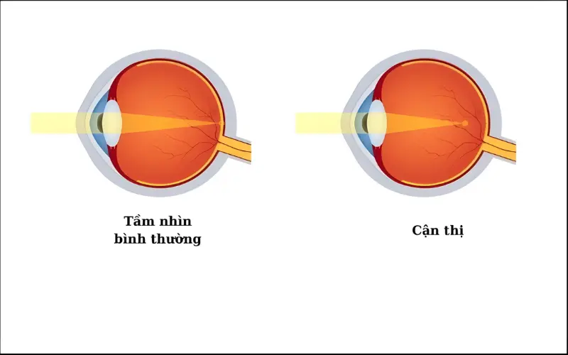 mắt cận thị do trục nhãn cầu dài ra