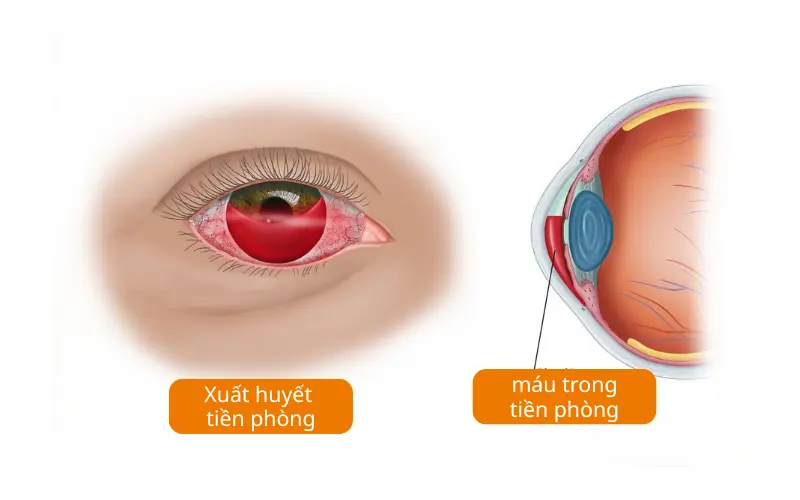 xuất huyết tiền phòng là gì