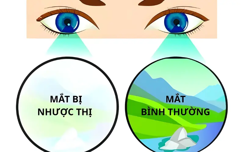 dấu hiệu của nhược thị