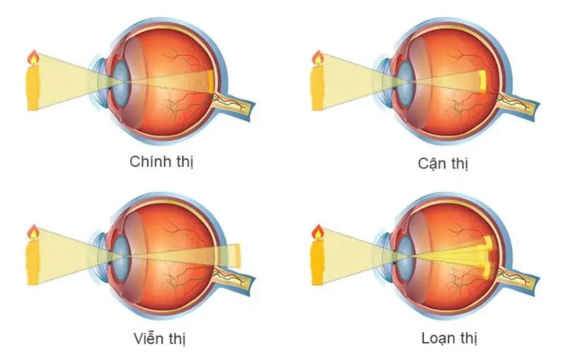 loạn viễn thị là gì