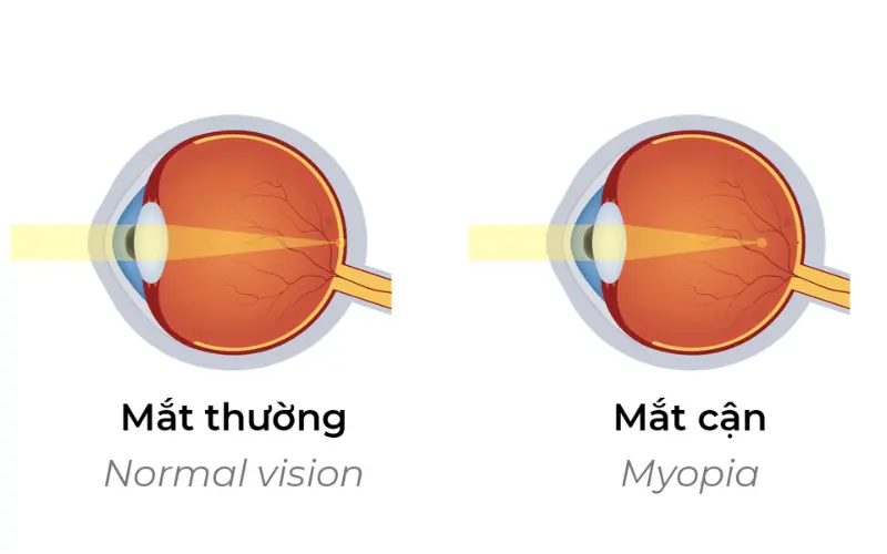 mắt thường và mắt cận