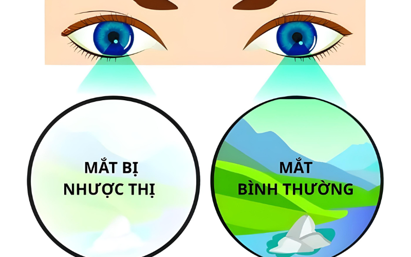 nhược thị có chữa được không