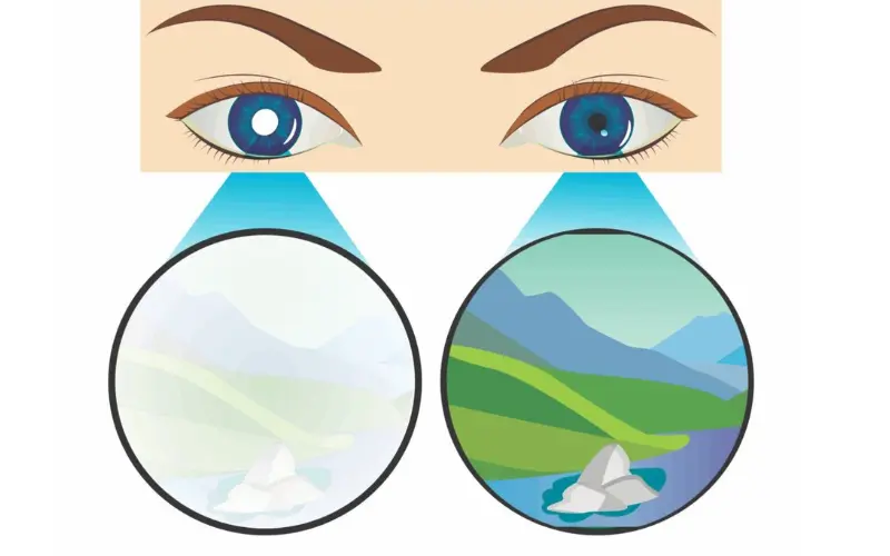 nhược thị là bị gì