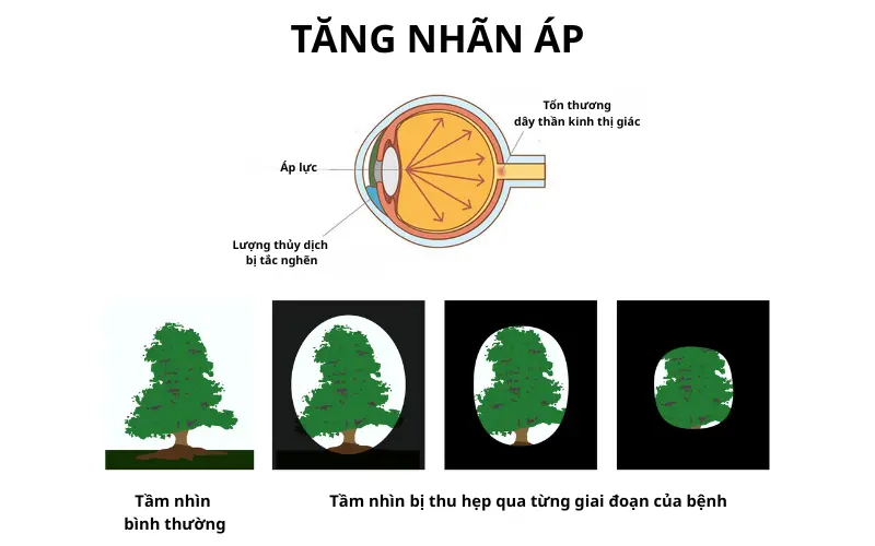 tăng nhãn áp nên làm gì