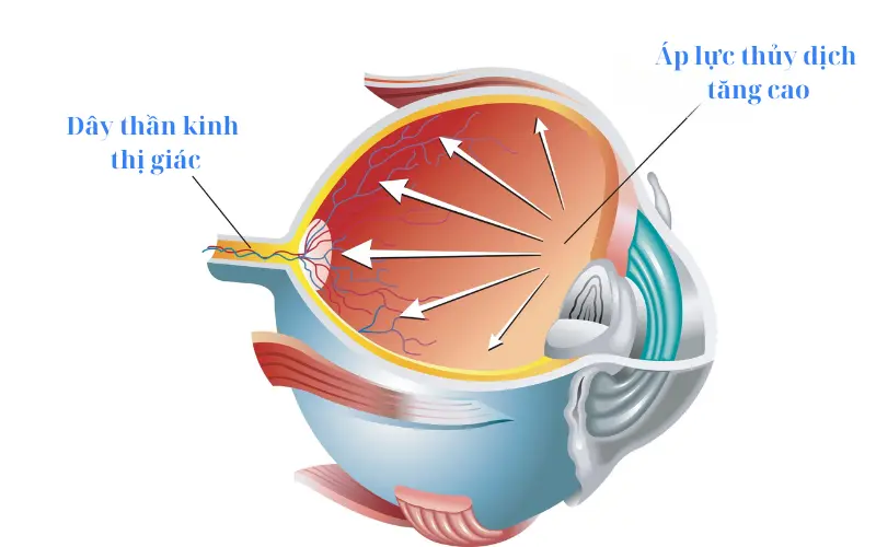tăng nhãn áp ở mắt