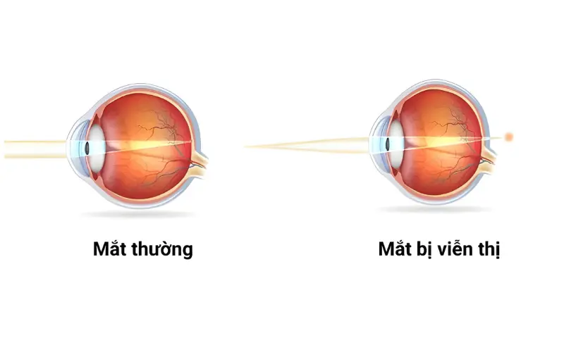viễn thị là như nào