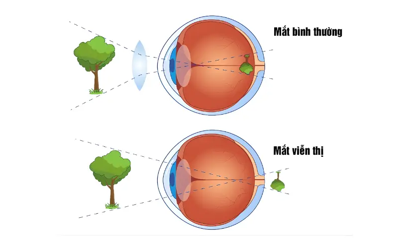 viễn thị nhìn xa hay gần