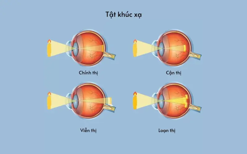 viễn thị và loạn thị là gì