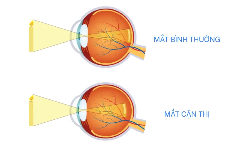 cận thị là sao
