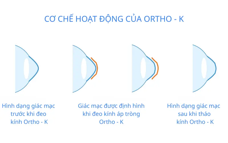 cơ chế hoạt động kính ortho K