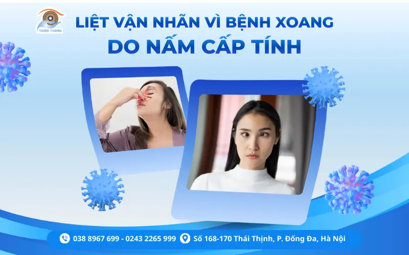 LIỆT VẬN NHÃN DO NẤM XOANG CẤP TÍNH