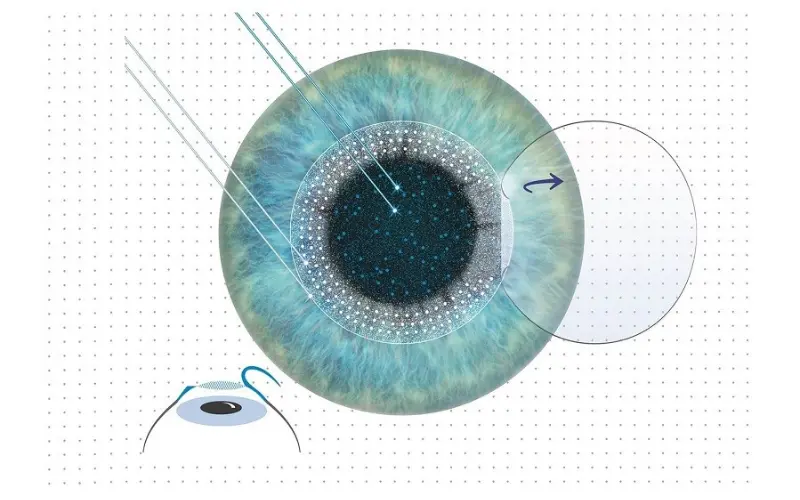 phương pháp femtosecond lasik