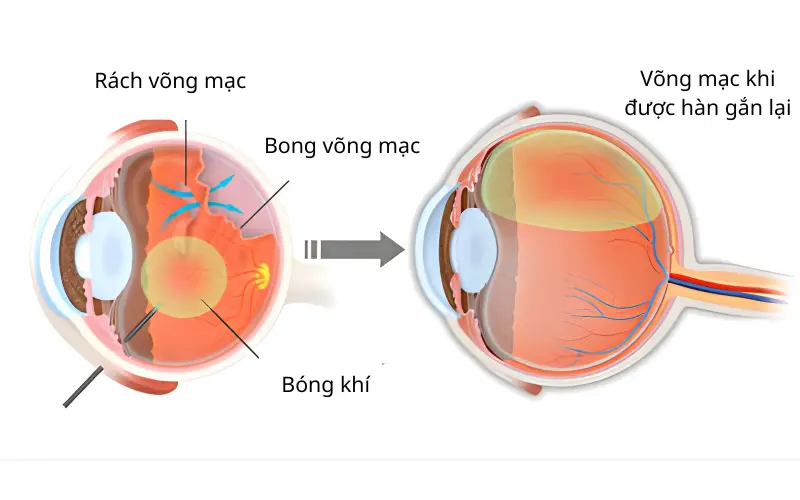 sử dụng bóng khi điều trị bong võng mạc