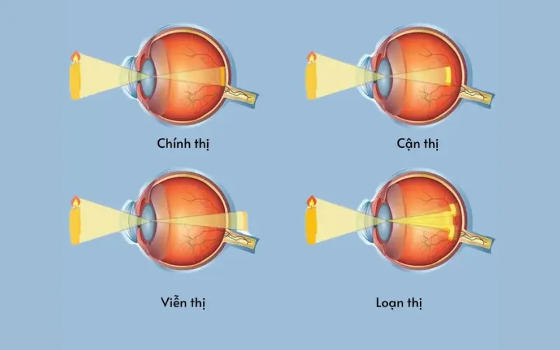 Tật khúc xạ 2 mắt là gì? Nguyên nhân, dấu hiệu và giải pháp điều trị