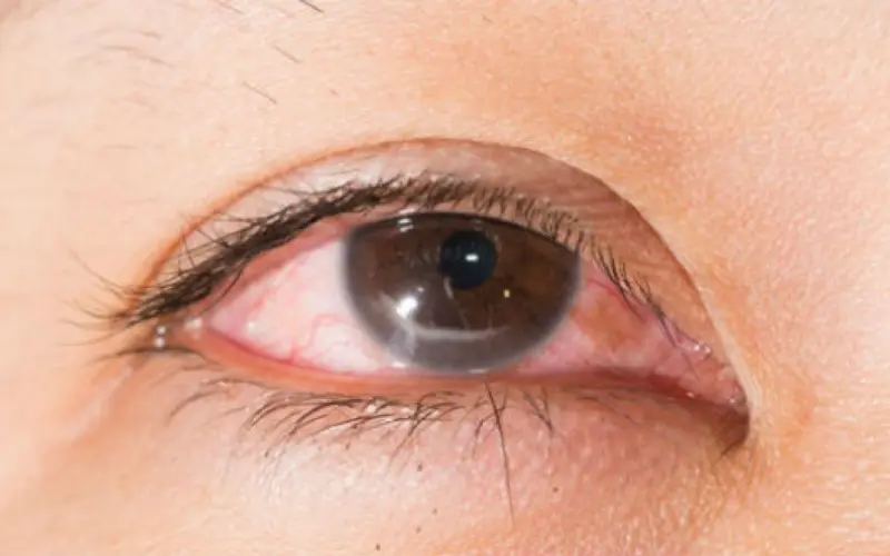 viêm giác mạc có sao không