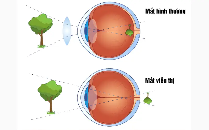 viễn thị ở mắt