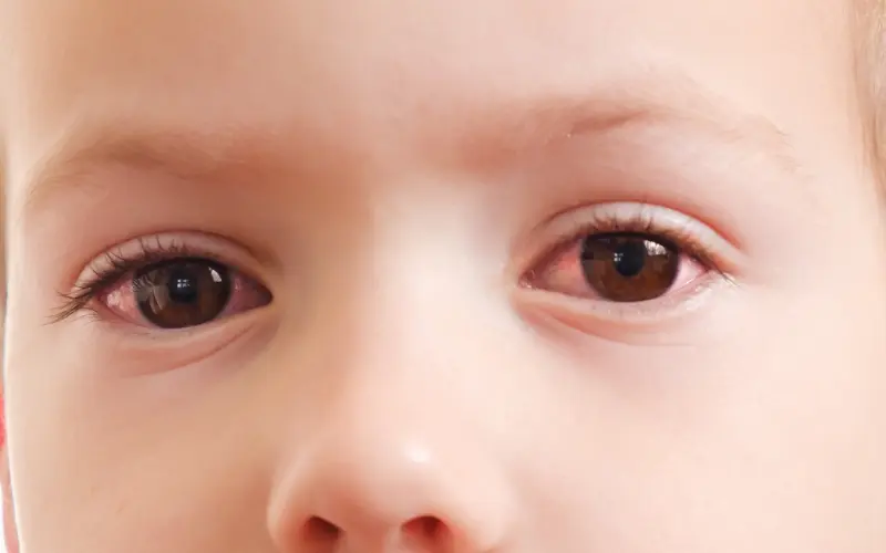 Giải đáp: Đau mắt đỏ và viêm kết mạc có giống nhau không?