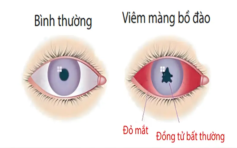 mắt bị viêm màng bồ đào