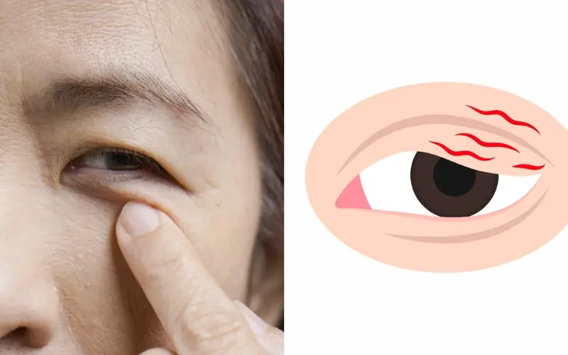 Mí mắt phải giật: Điềm báo tâm linh hay dấu hiệu cảnh báo sức khỏe?