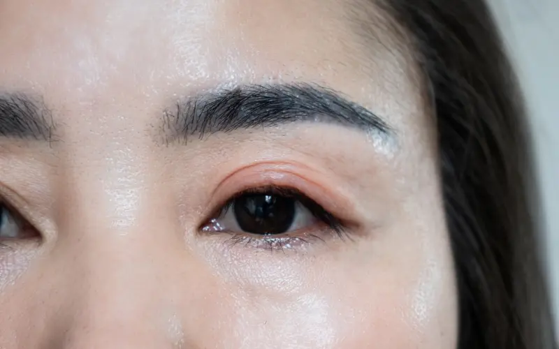 sưng đỏ mí mắt