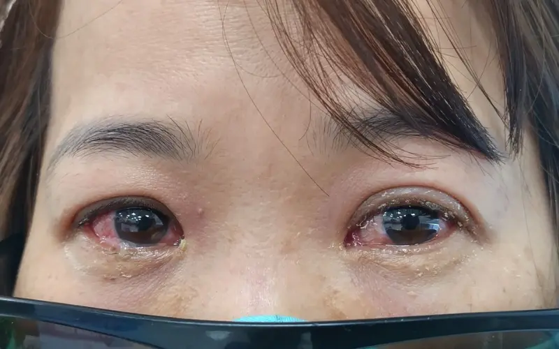 Viêm kết mạc do Adenovirus: Triệu chứng và cách điều trị