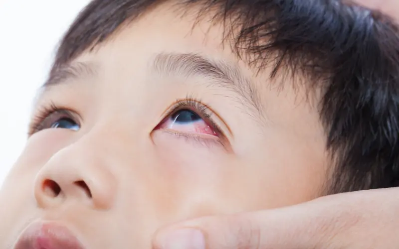 Viêm kết mạc ở trẻ em có lây không? Cách bảo vệ trẻ và gia đình hiệu quả
