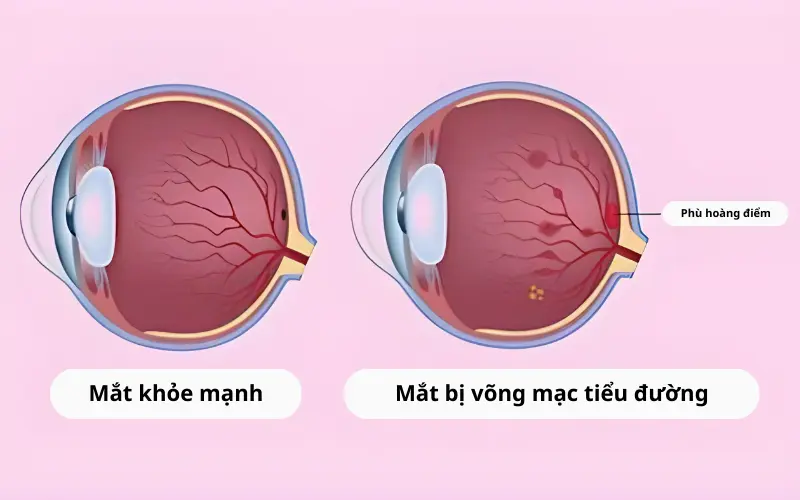 võng mạc tiểu đường