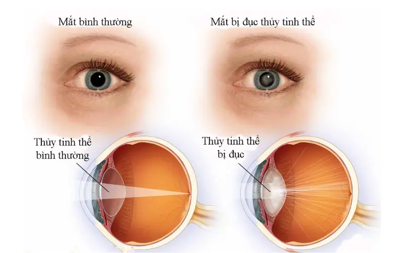 bệnh lý đục thủy tinh thể