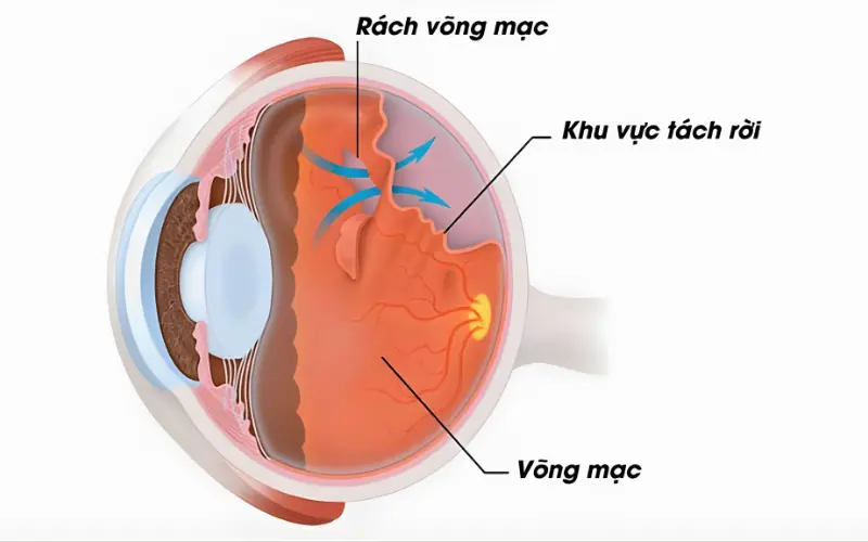 Rách võng mạc có nguy hiểm không? Cảnh báo sớm để tránh mù lòa