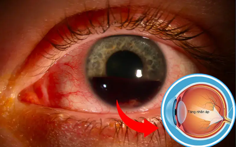 Tại sao xuất huyết tiền phòng gây tăng nhãn áp?