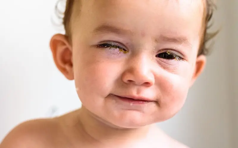 Viêm kết mạc ở trẻ sơ sinh: Nguyên nhân, dấu hiệu và cách điều trị an toàn