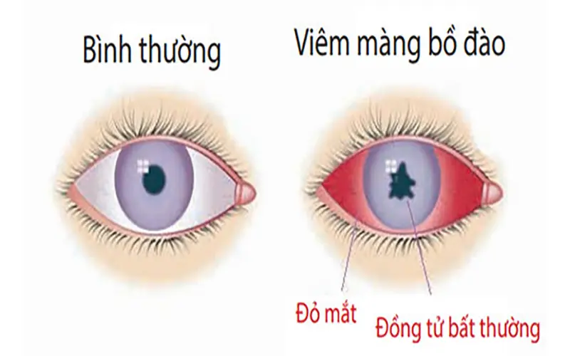 viêm màng bồ đào do đục thủy tinh thể