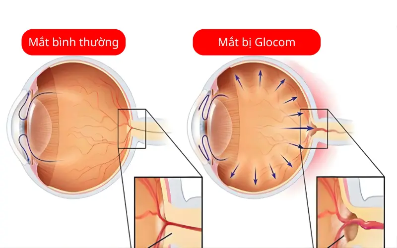 Glôcôm thứ phát là gì? Nguyên nhân và cách điều trị hiệu quả
