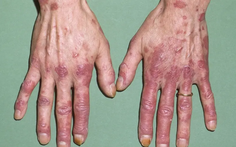 lupus ban đỏ