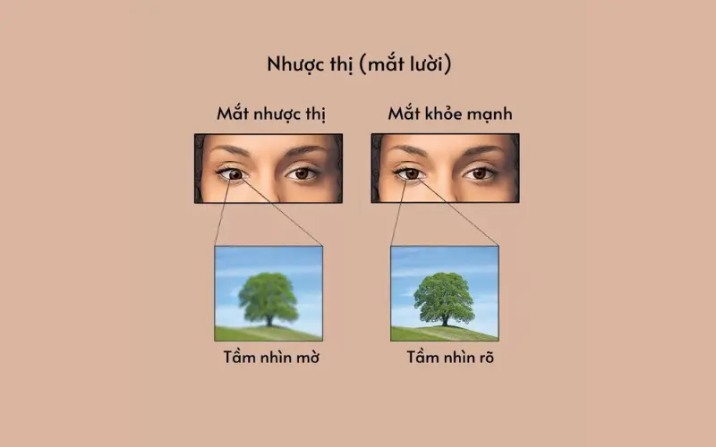 Mắt bị nhược thị