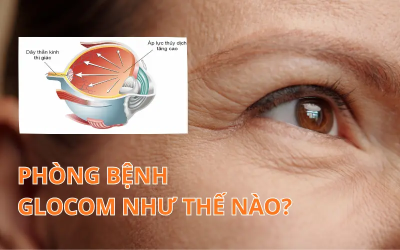 Phòng bệnh glocom: Những bí quyết vàng giúp bảo vệ thị lực sáng khỏe
