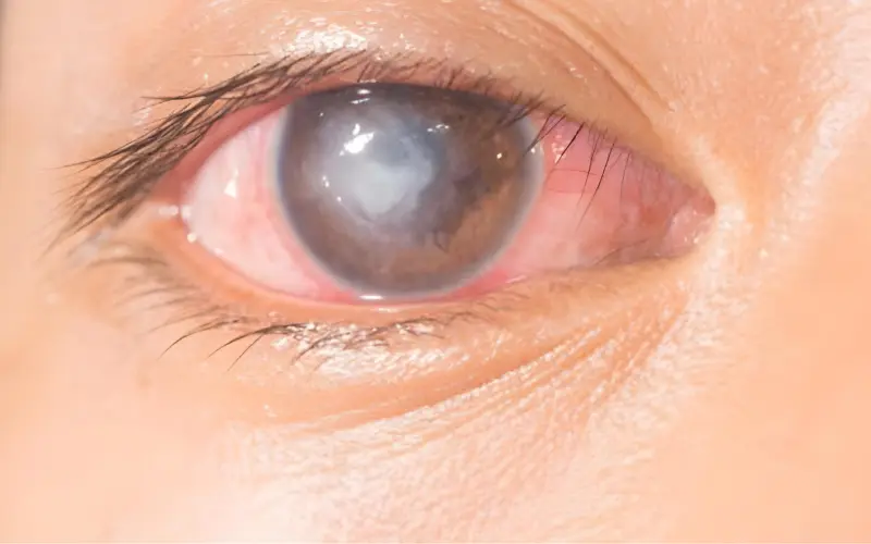 sẹo giác mạc