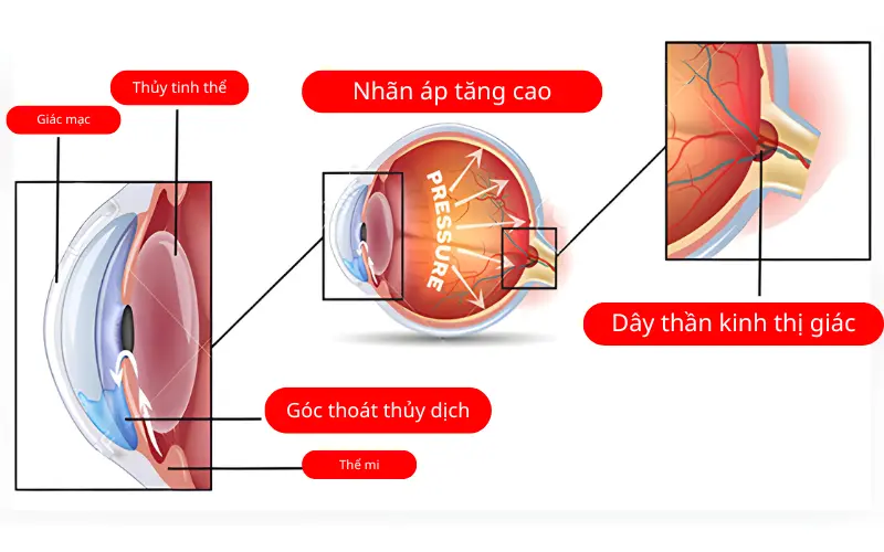 Tăng nhãn áp bao nhiêu là cao? Chỉ số bình thường và ngưỡng nguy hiểm