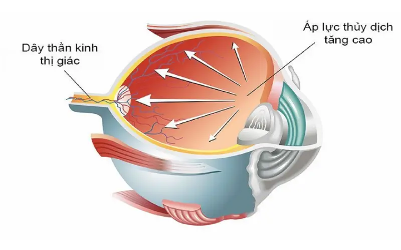 Tăng nhãn áp có tự khỏi không? Cảnh báo từ chuyên gia