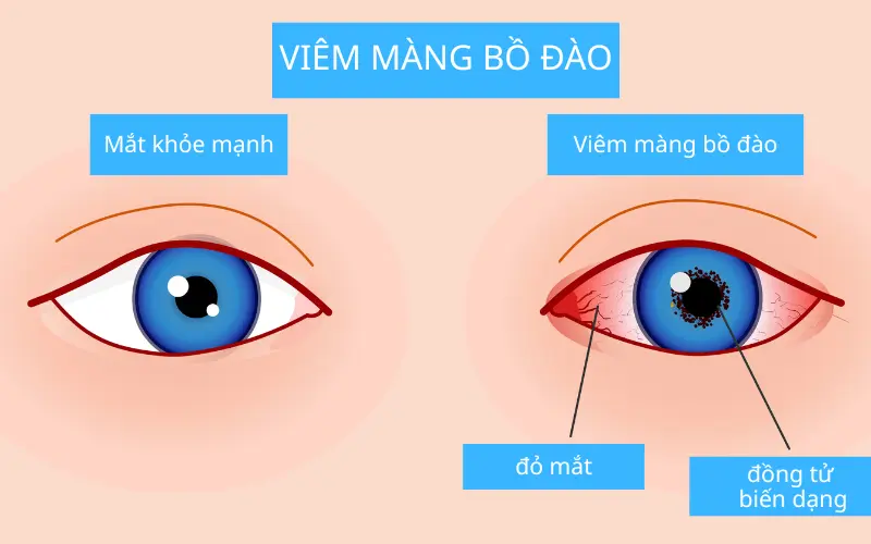 Viêm màng bồ đào có bị lây không? Giải đáp từ chuyên gia