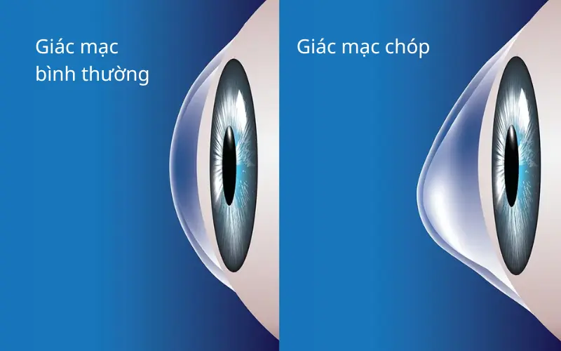 Giải đáp từ chuyên gia nhãn khoa: Bệnh giác mạc chóp có nguy hiểm không? 