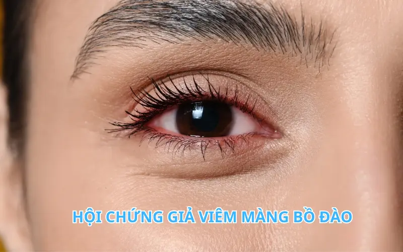 Hội chứng giả viêm màng bồ đào: Cẩn thận kẻ mạo danh nguy hiểm