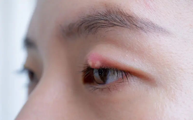 Mắt lên chắp: Hiểu đúng nguyên nhân và cách điều trị hiệu quả