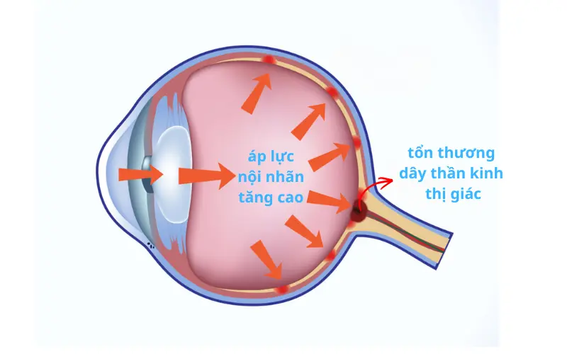 Tăng nhãn áp mắt là gì? Dấu hiệu nhận biết và cách điều trị