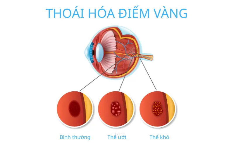 Thoái hóa điểm vàng có bị mù không? Sự thật và cách phòng ngừa biến chứng